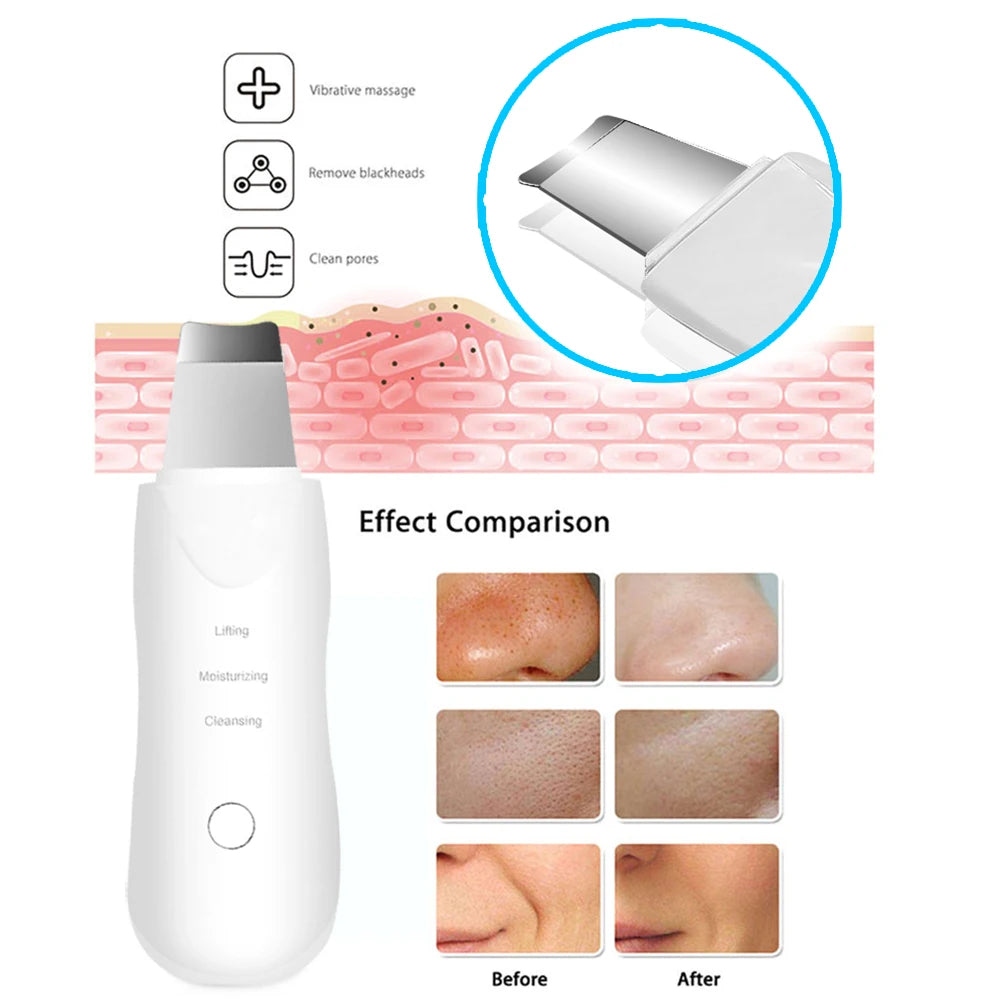 GlowLift™ Ultrasonic Skin Scrubber
